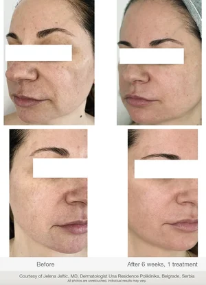 treatment of photoaging skin before and after photos