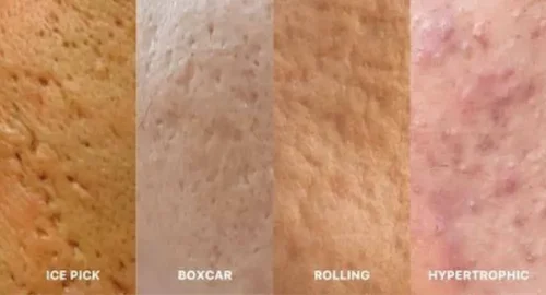 types of acne scars