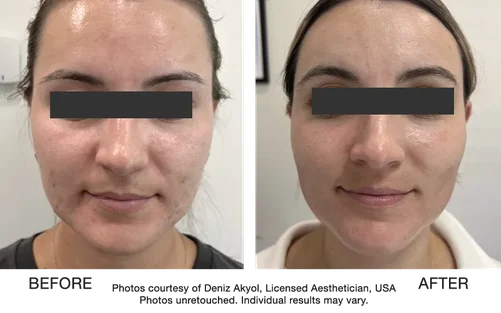 acne scars treatment