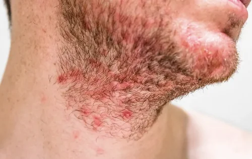 Gentle laser treatment for razor bumps