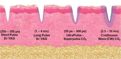 er:YAG laser for rosacea
