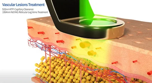 KTP laser