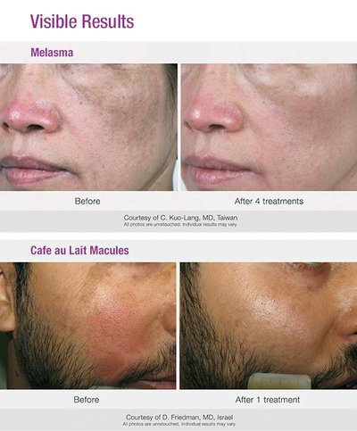 PicoWay melasma treatment