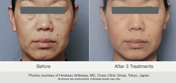 Matrix skin renewal treatment before and after photo