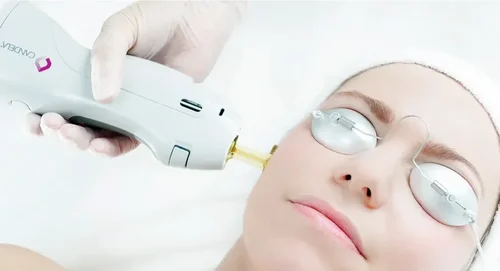Gentle laser facial treatment