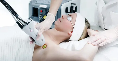 Gentle laser hair removal by Candela