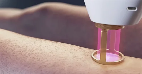 how Alexandrite laser hair removal works
