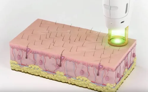nd:YAG laser for rosacea