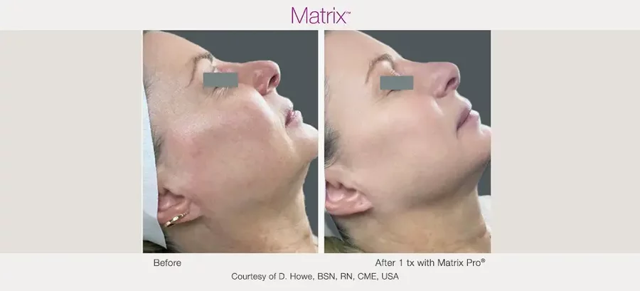 Matrix radiofrequency facial treatment