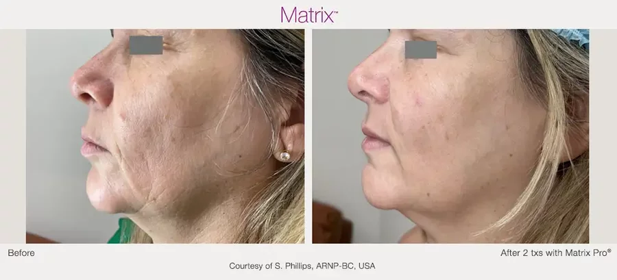 rf microneedling