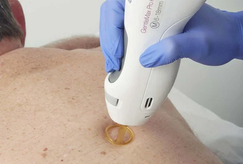 Gentle laser treatment for dark spots