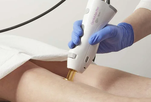 GentleMax Pro laser treatment