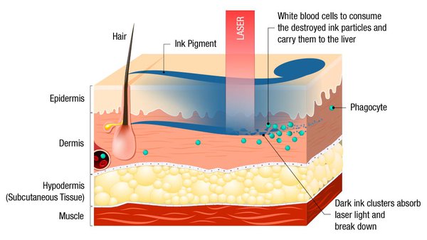 tattoo removal process