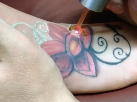 Eliminación de tatuajes