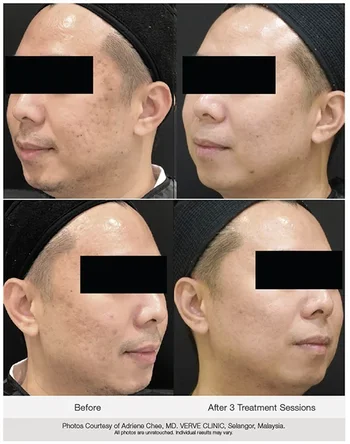 PicoWay laser for acne scars