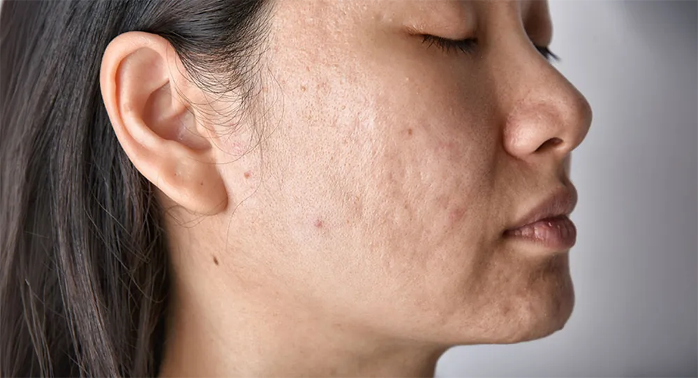 The best treatment for acne scars and skin texture