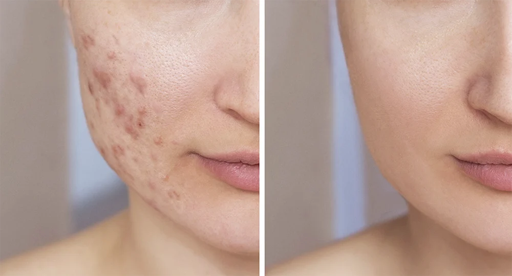 Acne facial treatment