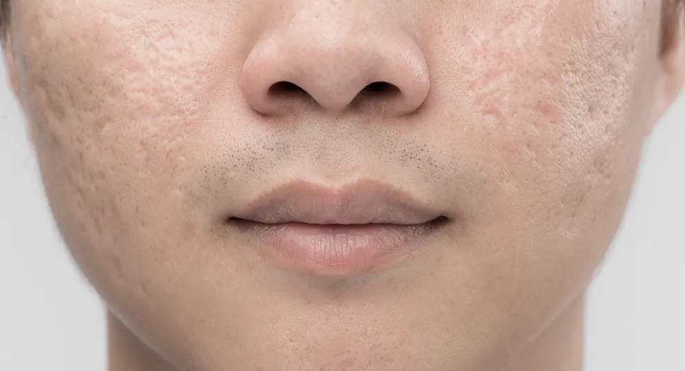 energy-based laser treatments for acne scars