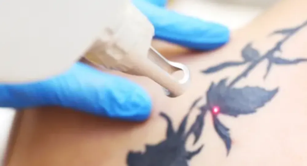 Tattoo removal laser machine