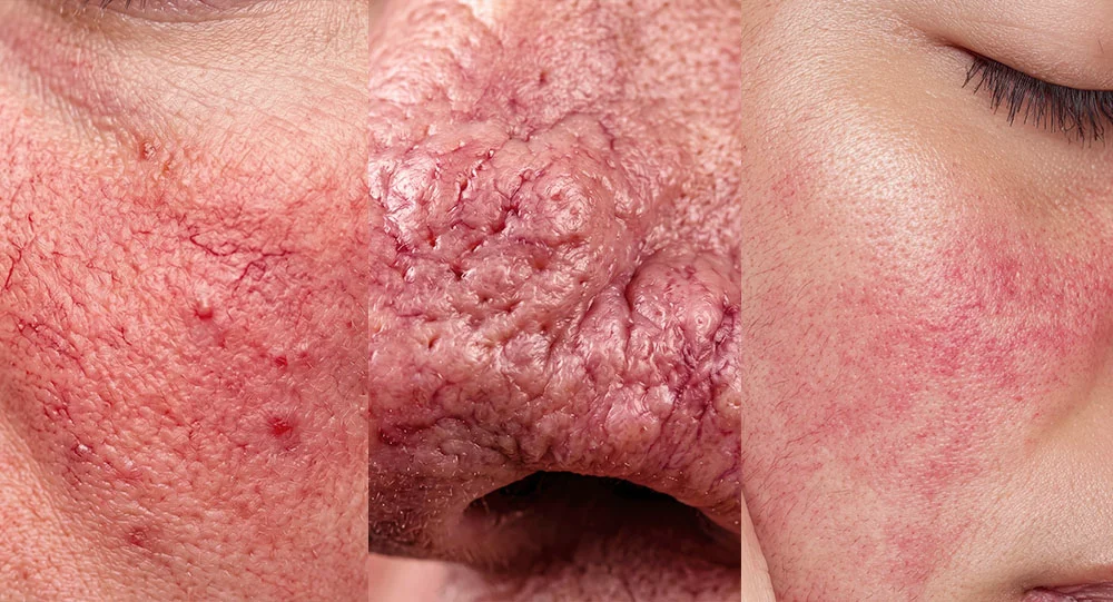 Laser treatments for rosacea