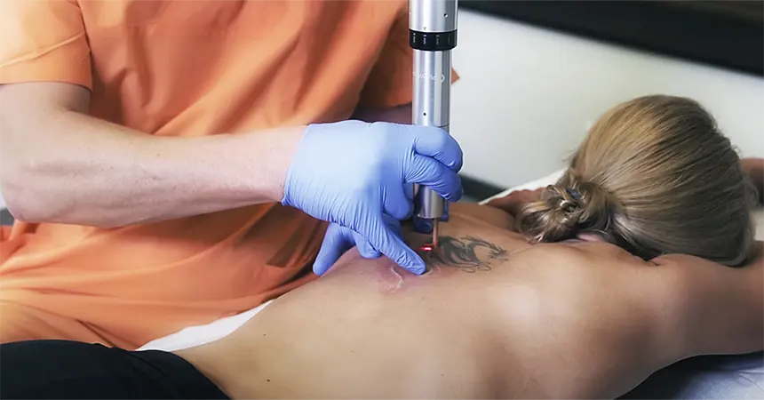 PicoWay laser tattoo removal technology