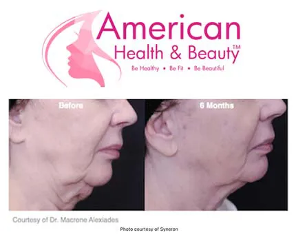 AmericanHealthBeauty-Profound-neck-lift-2015-Aug