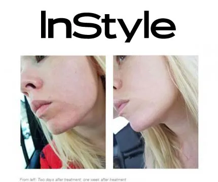 InStyle-Sublative-Laser-Resurfacing-2018-Aug